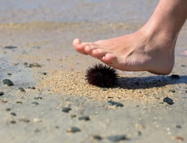Πάτησες αχινό, δράκαινα ή γυαλί στην παραλία; Τι πρέπει να κάνεις – Πως φεύγει ο πόνος